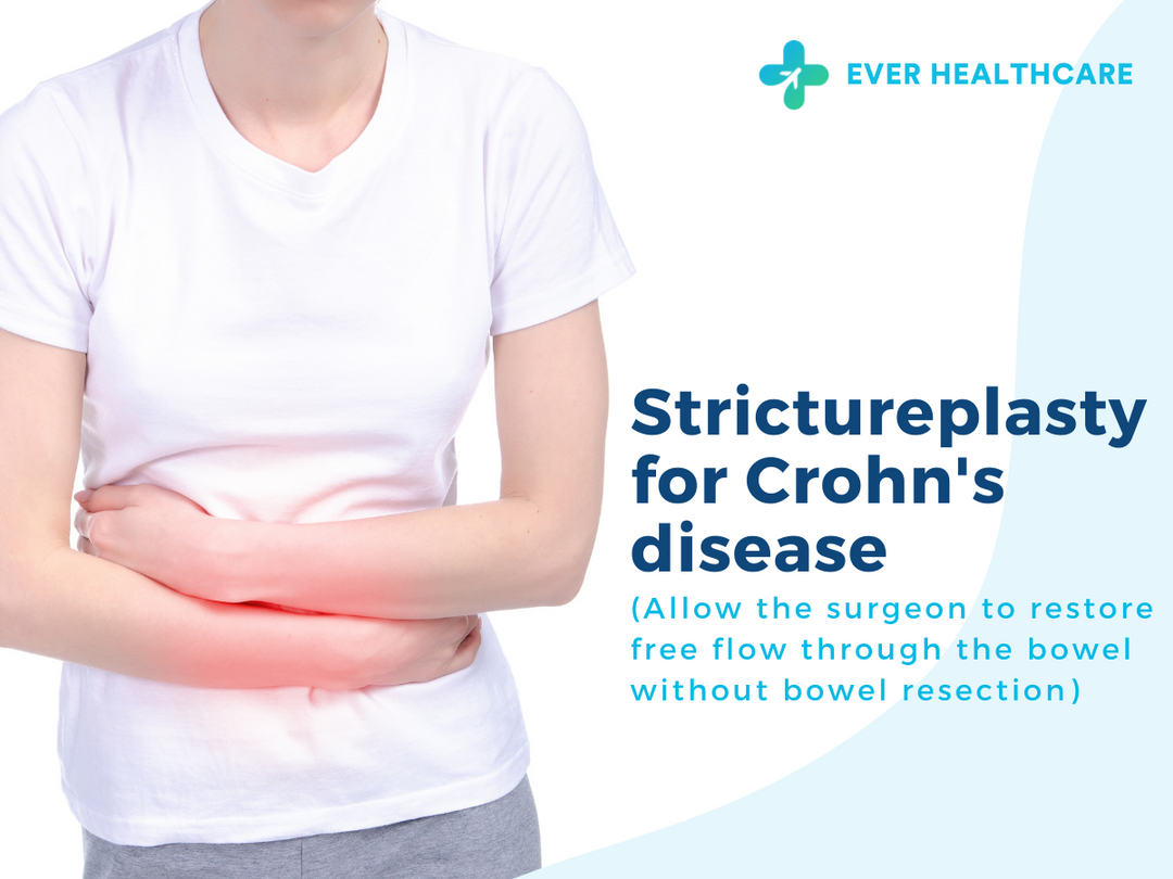 Strictureplasty for Crohn’s Disease in Thailand 2022 Compare Price